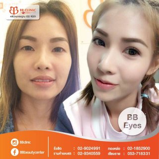 ผ่าตัดถุงใต้ตา 2ชั้น bb clinic